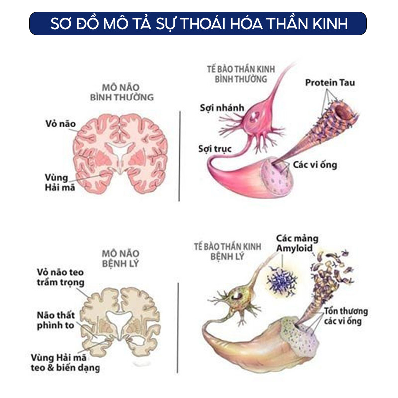 Sơ đồ mô tả sự thoái hóa thần kinh